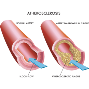 atherosclerosis